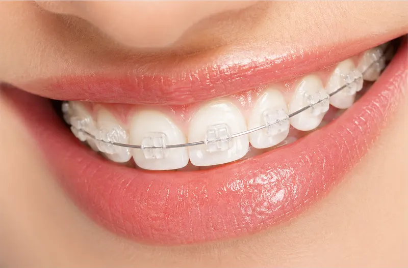 Tooth-colored ceramic braces