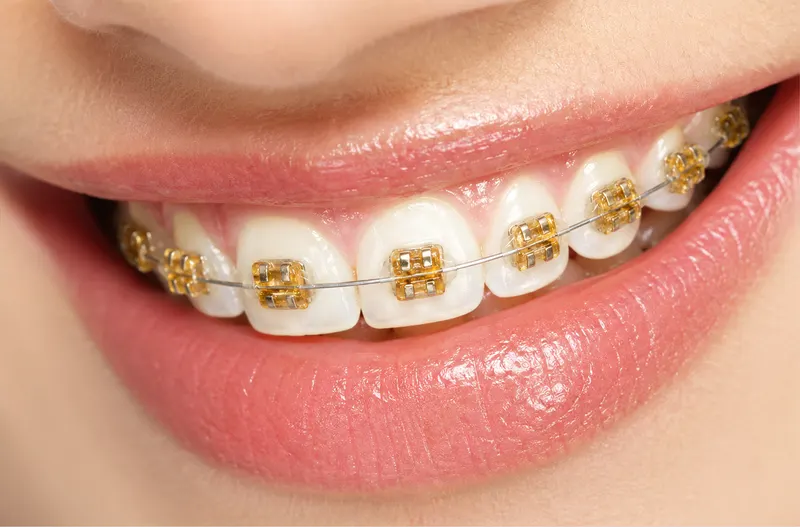 Gold-finish orthodontic braces