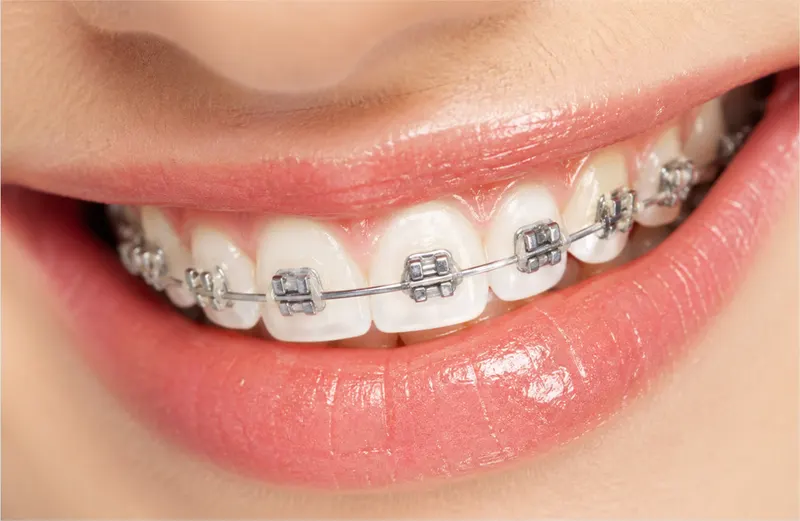 Classic metal orthodontic braces