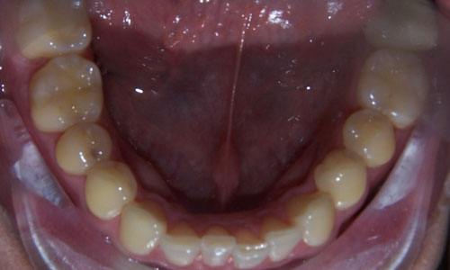 Patient smile before orthodontic treatment (case 1)