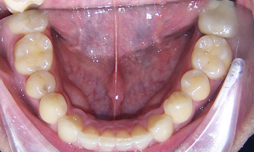 Patient smile after orthodontic treatment (case 1)