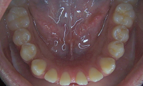 Patient smile before orthodontic treatment (case 3)