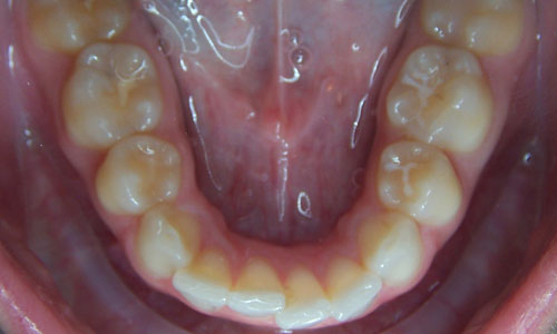 Patient smile before orthodontic treatment (case 16)