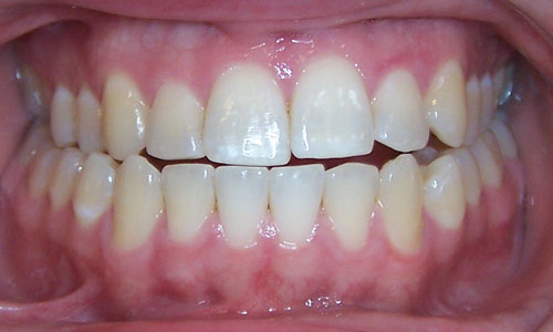 Patient smile before orthodontic treatment (case 23)