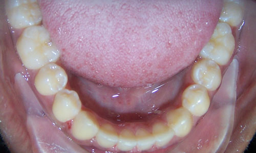 Patient smile after orthodontic treatment (case 3)