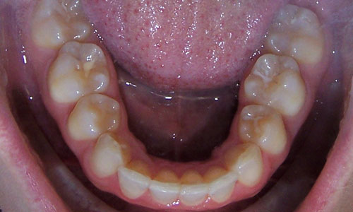 Patient smile after orthodontic treatment (case 16)