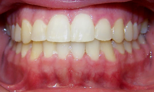 Patient smile after orthodontic treatment (case 23)