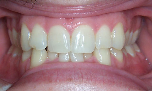 Patient smile before orthodontic treatment (case 11)