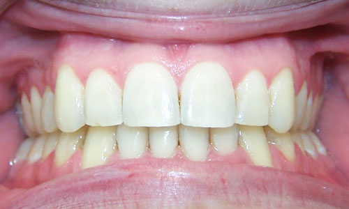 Patient smile after orthodontic treatment (case 11)