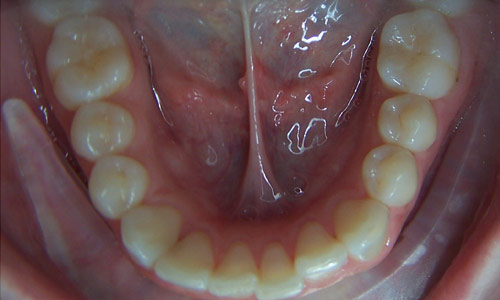 Patient smile before orthodontic treatment (case 2)