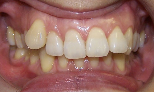 Patient smile before orthodontic treatment (case 22)