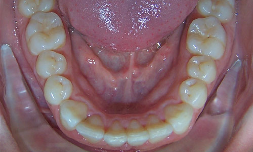 Patient smile after orthodontic treatment (case 2)