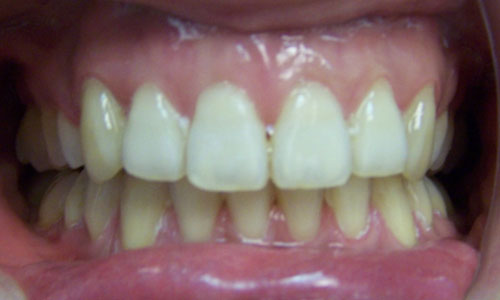 Patient smile after orthodontic treatment (case 22)