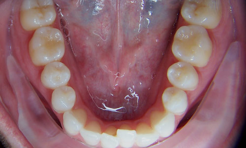 Patient smile before orthodontic treatment (case 10)