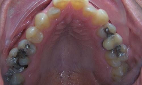 Patient smile before orthodontic treatment (case 12)