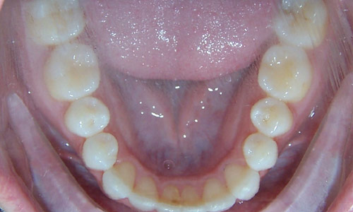 Patient smile after orthodontic treatment (case 10)
