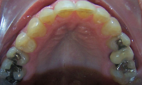 Patient smile after orthodontic treatment (case 12)
