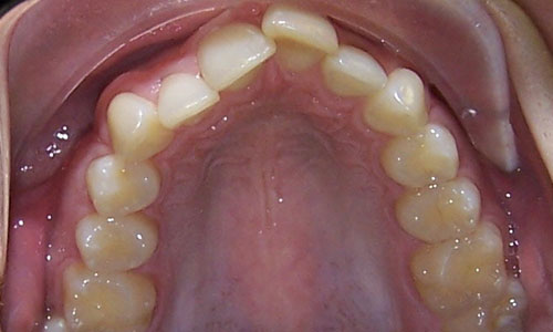 Patient smile before orthodontic treatment (case 23)