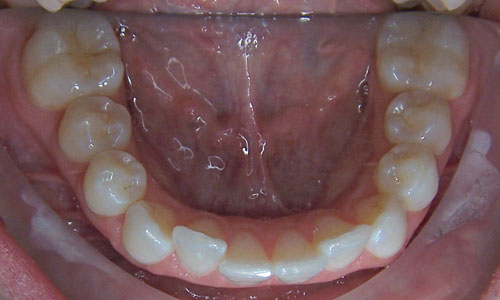 Patient smile before orthodontic treatment (case 17)