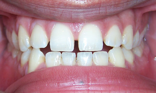 Patient smile before orthodontic treatment (case 6)