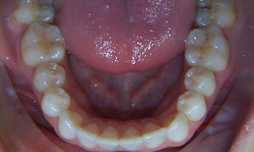 Patient smile after orthodontic treatment (case 17)