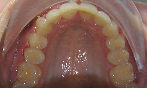 Patient smile after orthodontic treatment (case 23)