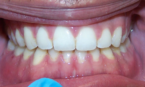 Patient smile after orthodontic treatment (case 6)