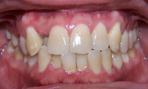 Patient smile before orthodontic treatment (case 14)