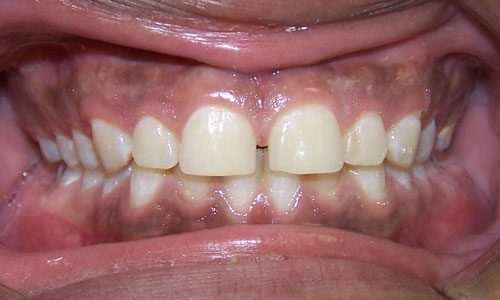 Patient smile before orthodontic treatment (case 3)