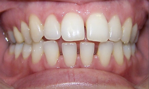 Patient smile before orthodontic treatment (case 1)