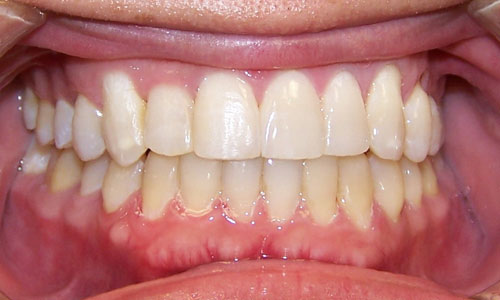 Patient smile after orthodontic treatment (case 14)
