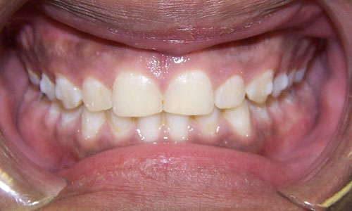 Patient smile after orthodontic treatment (case 3)