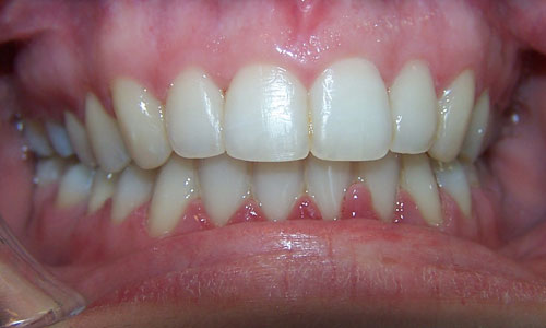 Patient smile after orthodontic treatment (case 1)
