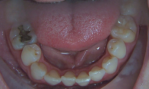 Patient smile before orthodontic treatment (case 11)