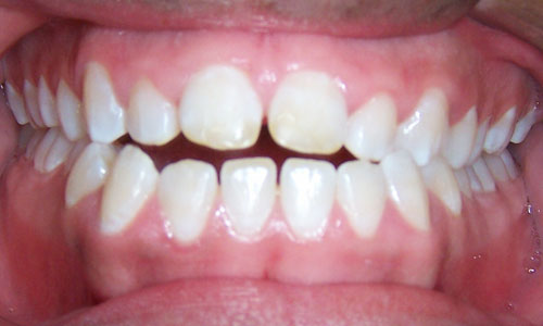Patient smile before orthodontic treatment (case 13)
