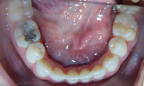 Patient smile after orthodontic treatment (case 11)