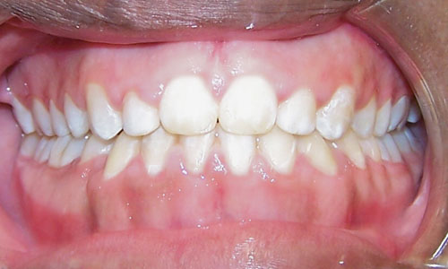Patient smile after orthodontic treatment (case 13)