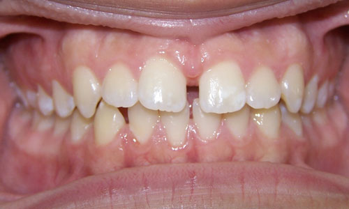 Patient smile before orthodontic treatment (case 24)
