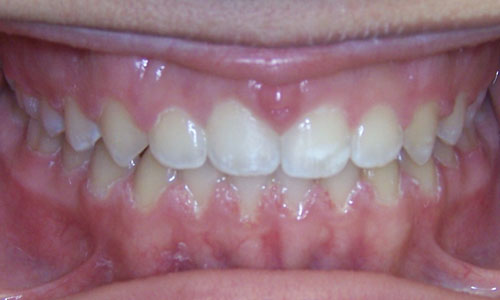 Patient smile after orthodontic treatment (case 24)