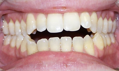 Patient smile before orthodontic treatment (case 25)