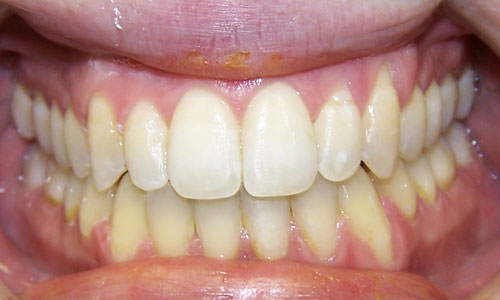 Patient smile after orthodontic treatment (case 25)