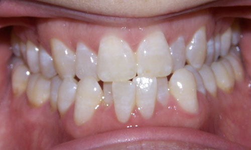 Patient smile before orthodontic treatment (case 15)
