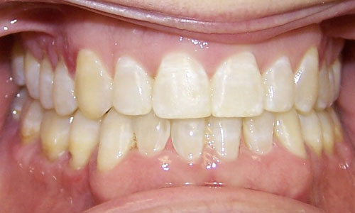 Patient smile after orthodontic treatment (case 15)