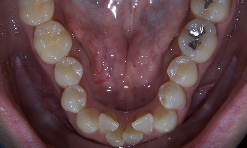 Patient smile before orthodontic treatment (case 26)