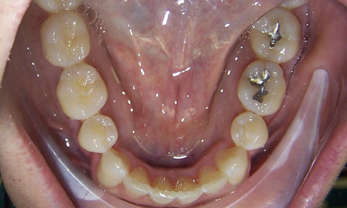 Patient smile after orthodontic treatment (case 26)