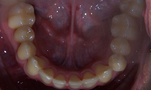 Patient smile before orthodontic treatment (case 18)