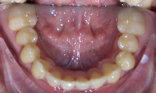 Patient smile after orthodontic treatment (case 18)