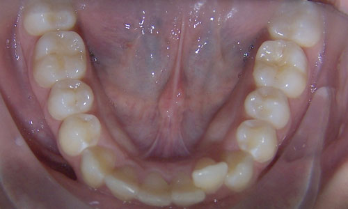 Patient smile before orthodontic treatment (case 4)