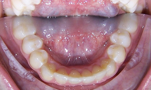 Patient smile after orthodontic treatment (case 4)