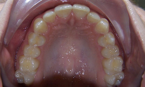 Patient smile before orthodontic treatment (case 12)